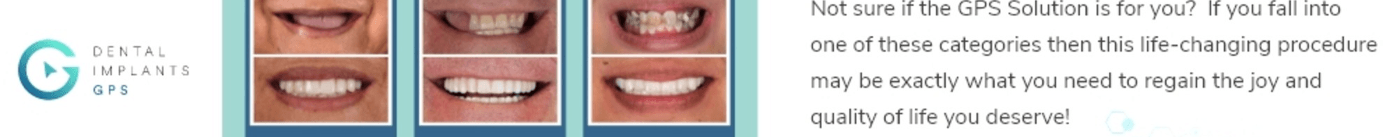 Dental Implants GPS's Cover Image