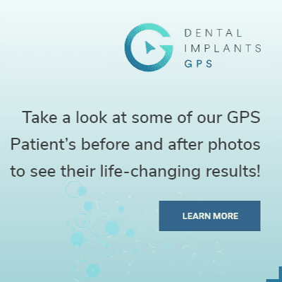 Dental Implants GPS - Gallery Photo